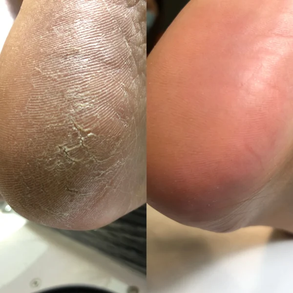 NAILSOFTHEDAY Podology+ Keratolytic for feet, 100 ml - Image 4