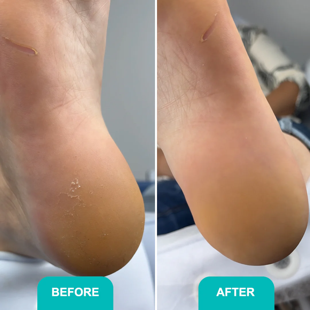 Сallus and corns softening gel Soft blade Shelly 200 ml obrázek 4 Сallus and corns softening gel Soft blade Shelly 200 ml - Obrázek 4