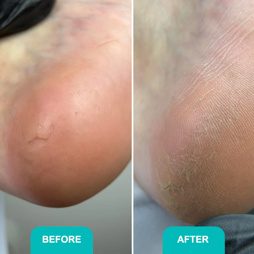 Сallus and corns softening gel Soft blade Shelly 200 ml obrázek 6 Сallus and corns softening gel Soft blade Shelly 200 ml - Obrázek 6